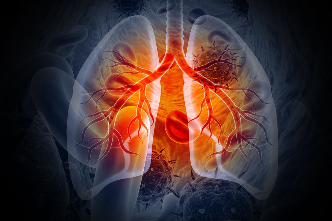 Lung Cancer Research Gains $400,000 in New Support