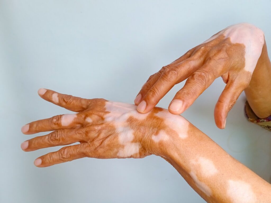 Close-up of hands with vitiligo skin patches, highlighting awareness supported by the Vitiligo Innovators Program.