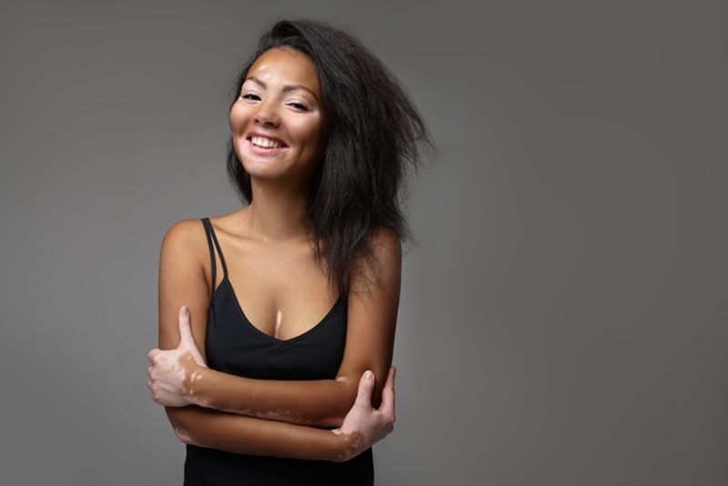 Vitiligo Innovators Program: Recognizing Community Leaders