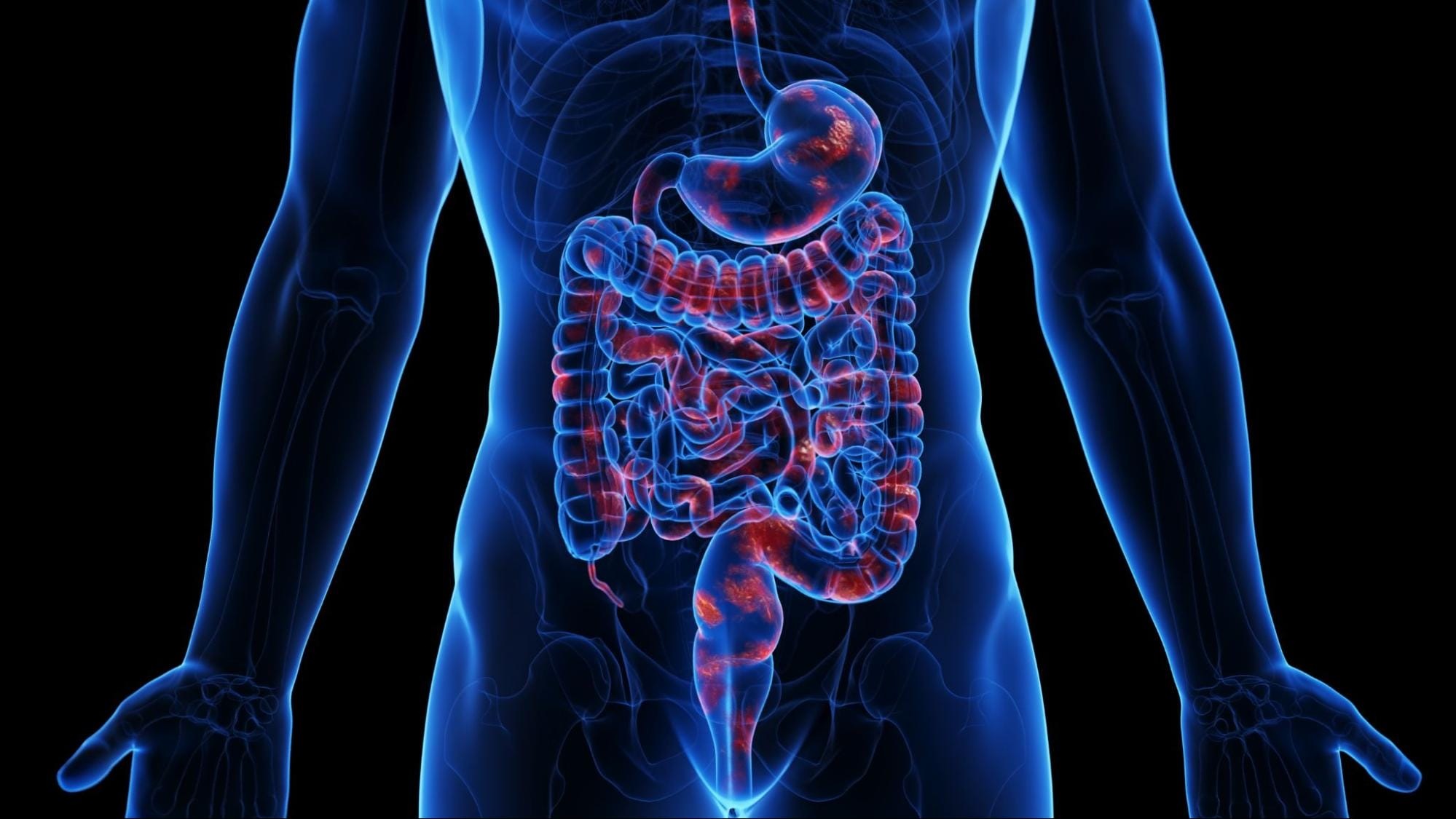 Crohn’s Disease Clinical Trial: What Patients Should Know