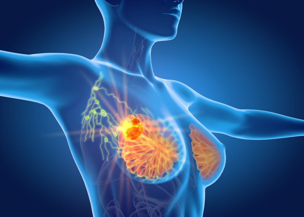 3D medical illustration showing tumor cells spreading in female anatomy to represent metastatic breast cancer developments. 