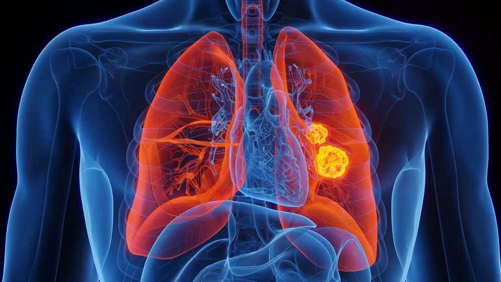 3D anatomical illustration of human lungs highlighting glowing yellow tumor masses, depicting non-small cell lung cancer inside the chest cavity.