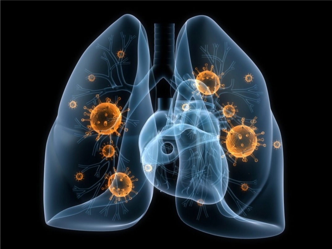 What Should You Know About Non-Small Cell Lung Cancer?
